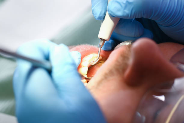 Best Emergency Root Canal Treatment in Country Clu, CA